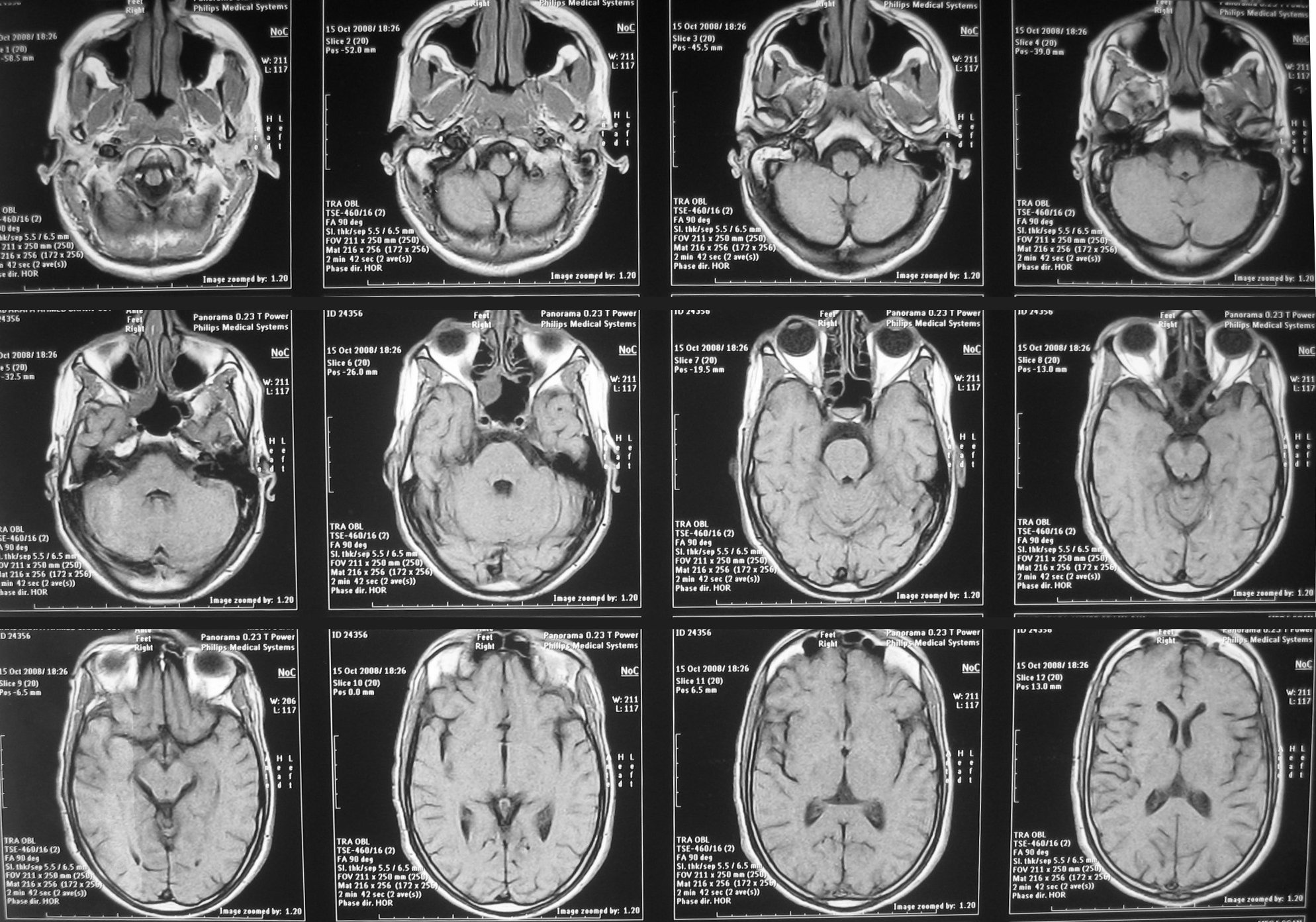 В ТГУ смогли «вживую» увидеть, как организм лечит мозг после инсульта