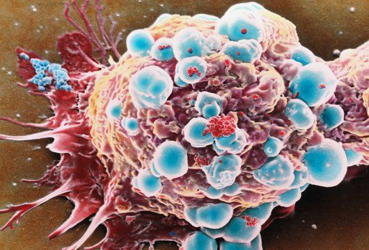 Клетка рака груди / ©Science Photo