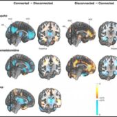 Различия в мозговой активности между состояниями сознания изучались с помощью позитронно-эмиссионной томографии (ПЭТ) / ©JNeurosci