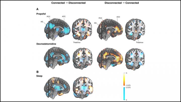 Различия в мозговой активности между состояниями сознания изучались с помощью позитронно-эмиссионной томографии (ПЭТ) / ©JNeurosci