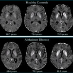 Лекарство от болезни Альцгеймера показало эффективность в испытаниях второй фазы