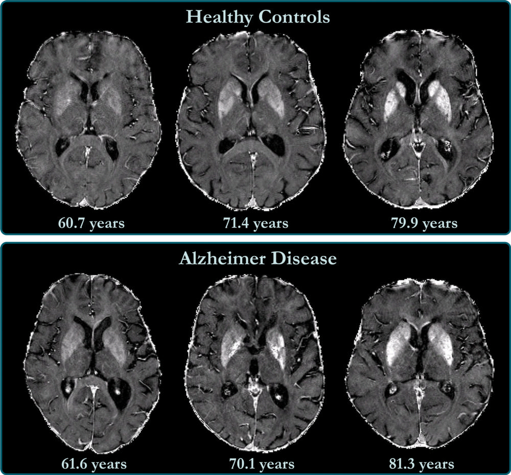 Лекарство от болезни Альцгеймера показало эффективность в испытаниях второй фазы