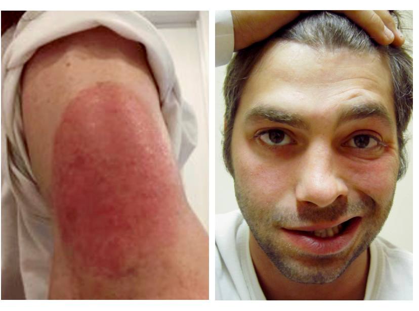Слева — реакция на укол вакциной mRNA-1273 от американской компании Moderna; справа — временный паралич части лица (паралич Белла) после препарата от Pfizer 