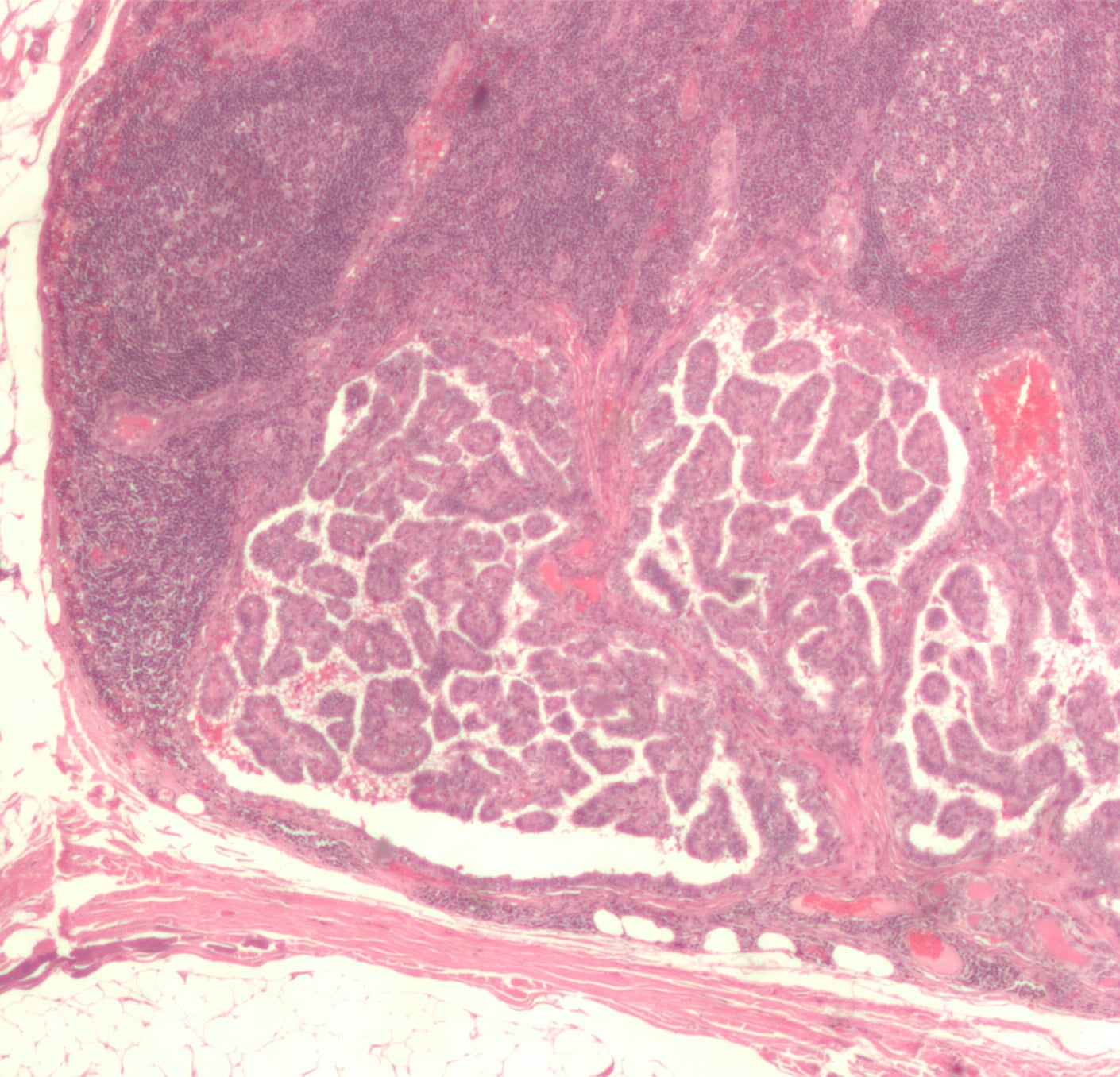Микрограф рака щитовидной железы / ©Wikipedia