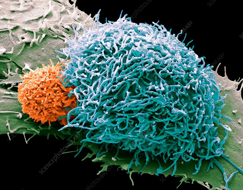 Лимфоцит атакует раковую клетку. Фото сделано при помощи сканирующей электронной микроскопии / ©Іс Science Photo Library
