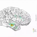 Трехмерная карта показала область мозга, ответственную за эпилептический приступ