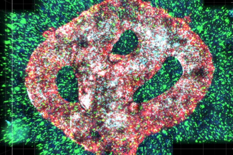 На микрофотографии распечатанной опухоли видны сосуды (красные), клетки микроглии (зеленые) и самой глиобластомы (синие)