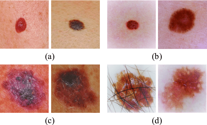 Обзор рака кожи и меланомы