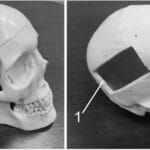 Российские ученые создали биосовместимую пластину для коррекции дефектов черепа