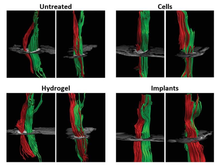 Визуализация поврежденных (красные) и неповрежденных (зеленые) нервных волокон спинного мозга. Левая часть каждого изображения – вид спереди; правая часть – вид сбоку.