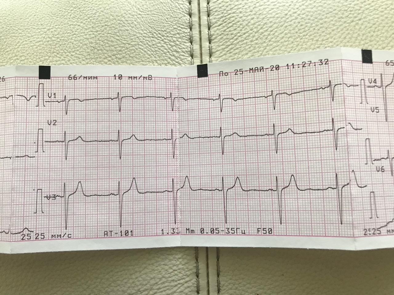 Тюменские врачи показали динамику течения нарушений ритма сердца после удара током
