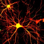«Нейроны всмятку»: болезнь Альцгеймера связали с перегревом клеток мозга