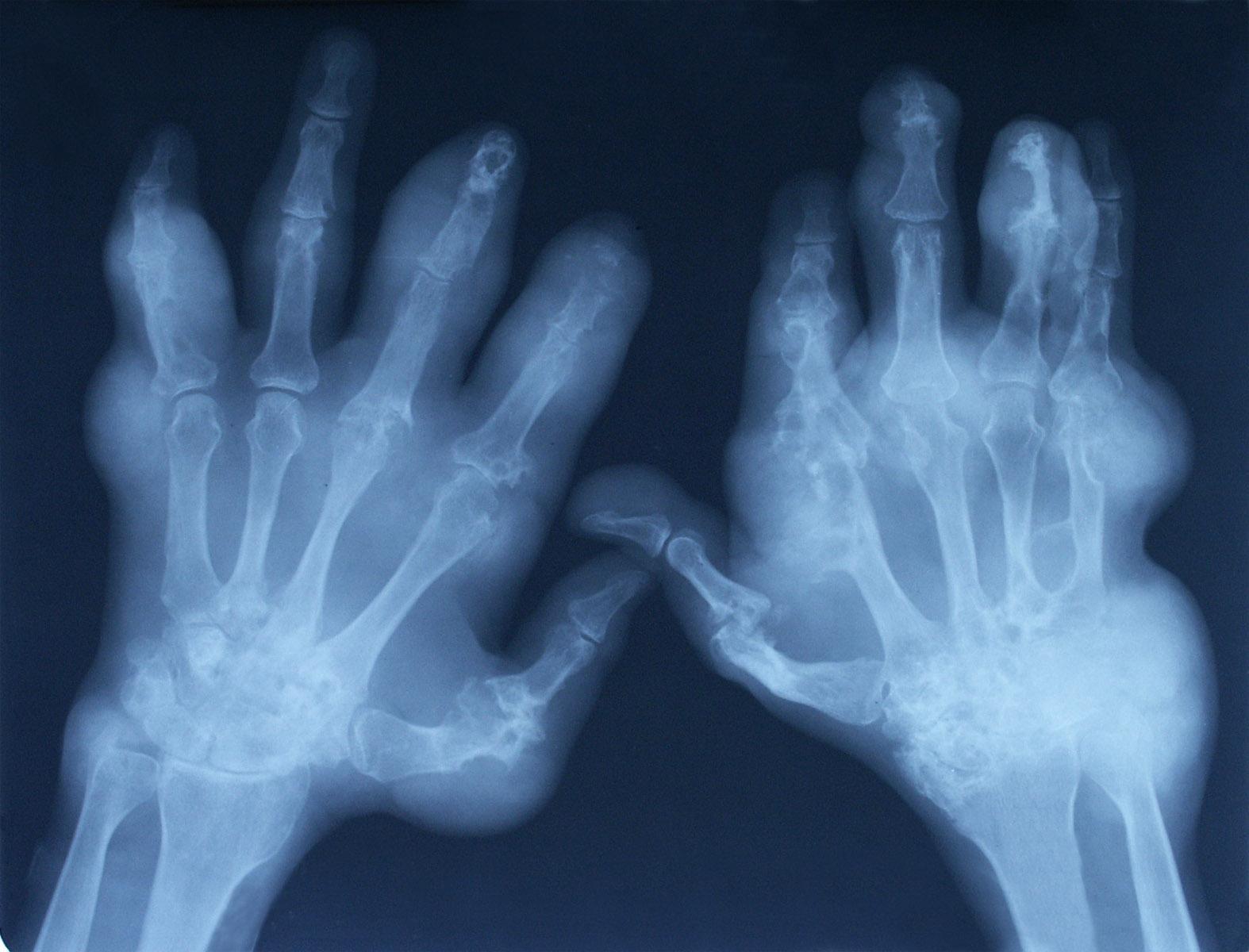 Ревматоидный артрит кисти рентген