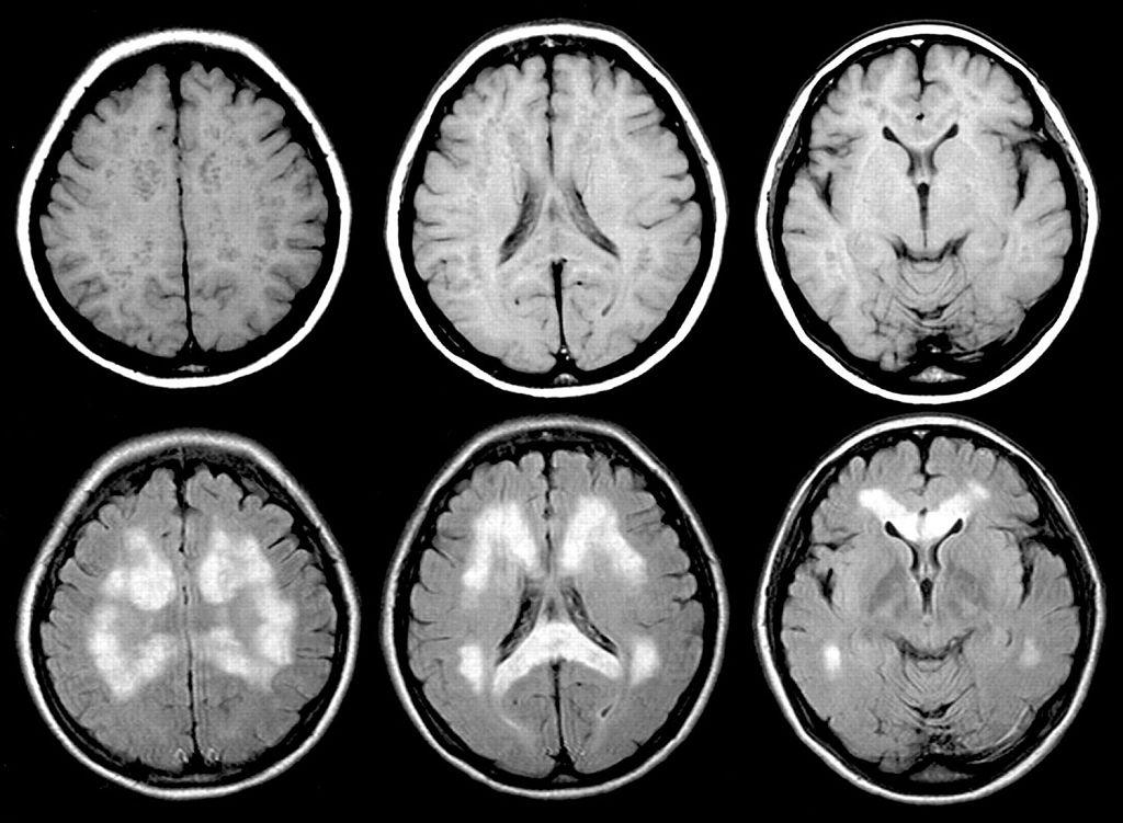 Искусственный интеллект помог определить оптимальный метод для диагностики болезни Паркинсона