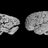 Мозг больного деменцией и здорового человека