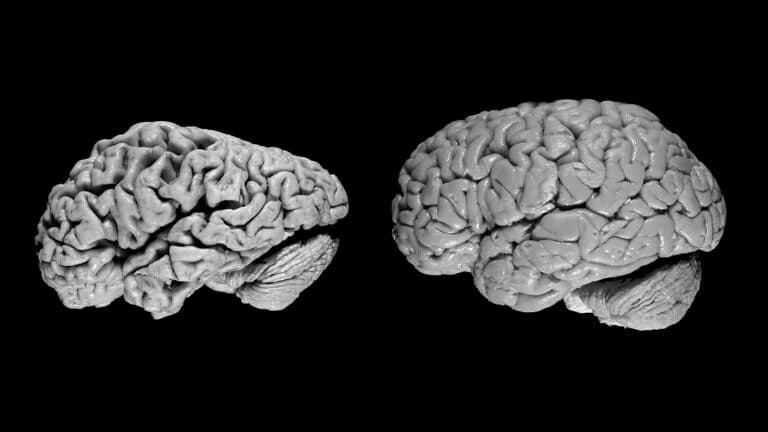Мозг больного деменцией и здорового человека