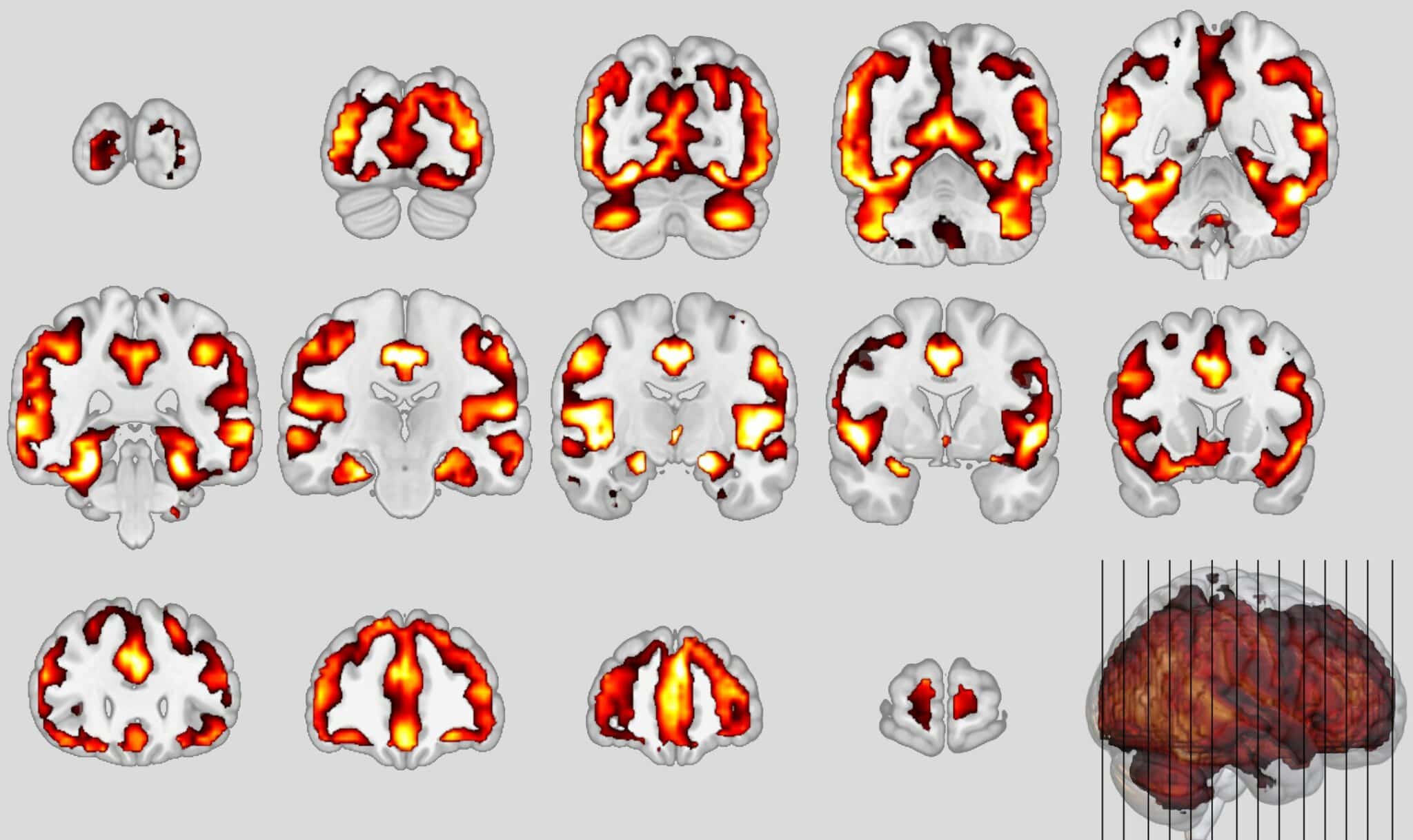 Впервые обнаружено сходство между шизофренией и деменцией