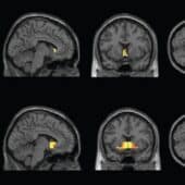 Сравнение активности мозга зависимых от порнографии и условно здоровых людей. Исследования показывают, что первые реагируют на раздражители так же, как зависимые от алкоголя и психоактивных веществ