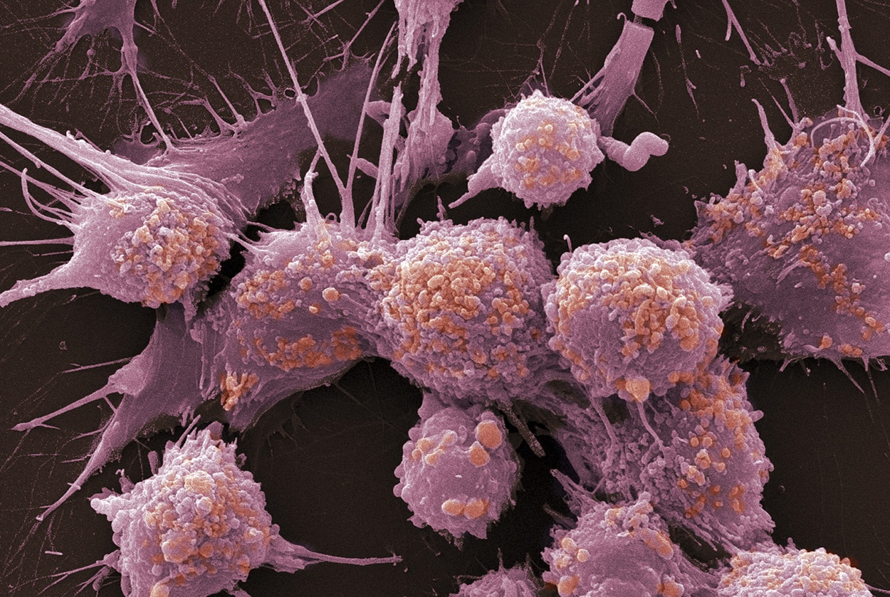 Микропузырьки улучшат альтернативную терапию против рака