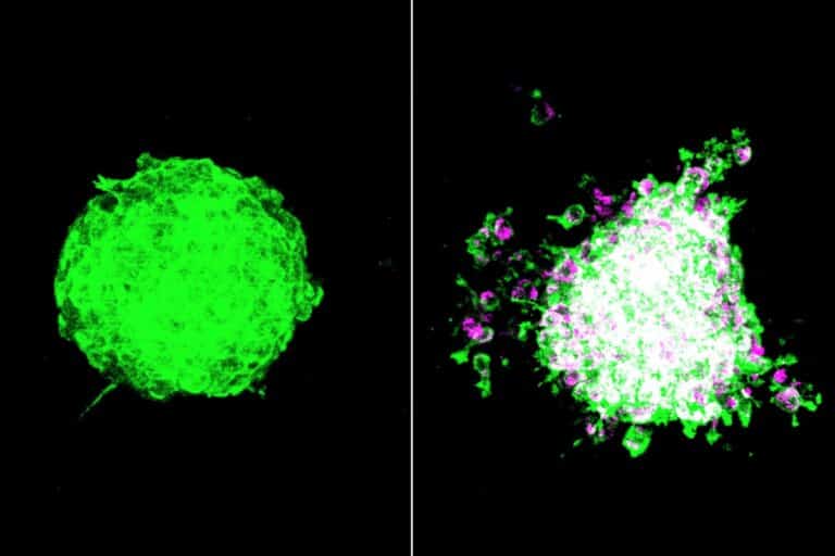 Слева — сфероид опухолевых клеток, справа — такой же сфероид, заселенный бактериями Fusobacterium nucleatum (окрашены розовым)