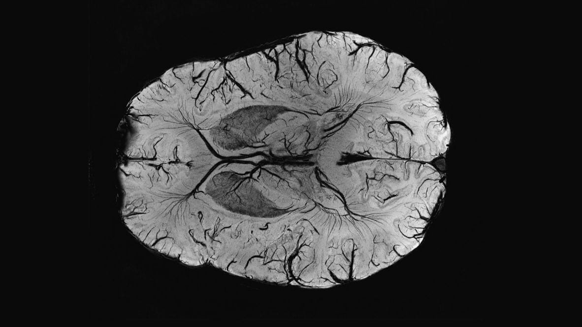 Аномалии мозга после Covid-19 обнаружили на снимках МРТ