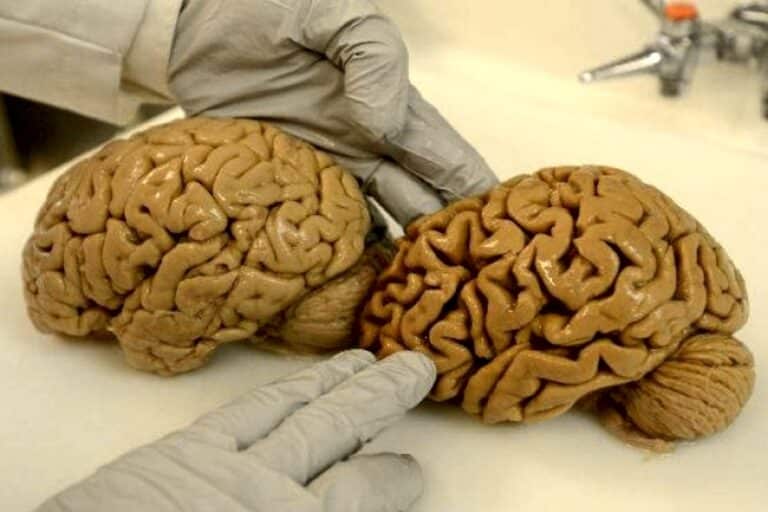 Слева — здоровый мозг, справа — мозг с нейродегенеративными поражениями