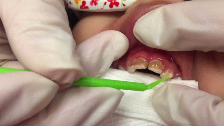 Серебрение зубов двухлетней пациентке