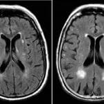 Стимуляция природного «фильтра» мозга повысит эффективность лечения Альцгеймера