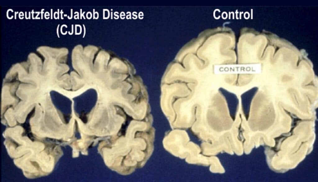 Справа — здоровый мозг, слева — разрушенный прионами (болезнью Крейтцфельдта — Якоба)