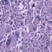 Клетки глиобластомы под микроскопом