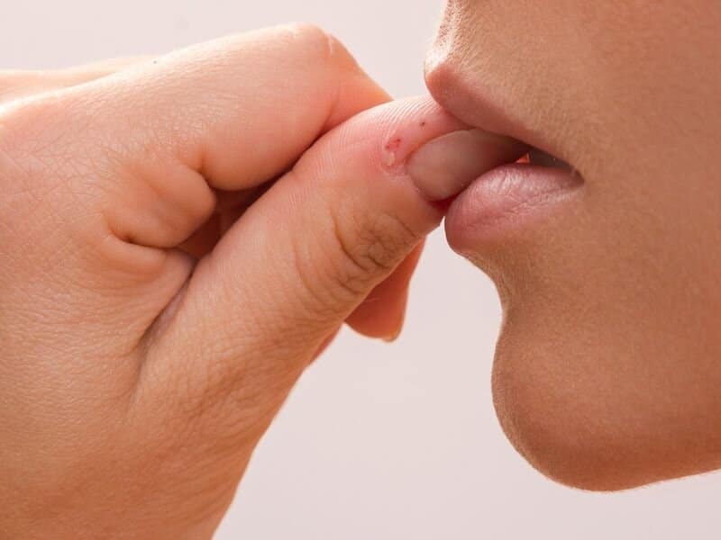 Ученые рассказали, как избавиться от привычки грызть ногти