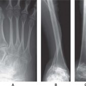 Рентгеновский снимок костей человека с несовершенным остеогенезом