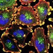 Клетки меланомы под микроскопом; ядра окрашены синим