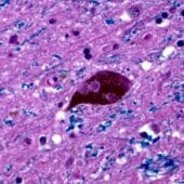 Тельце Леви в тканях мозга больного паркинсонизмом
