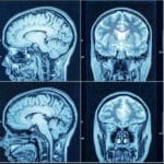 Сотрясение мозга в молодости ухудшило мышление и память в старости