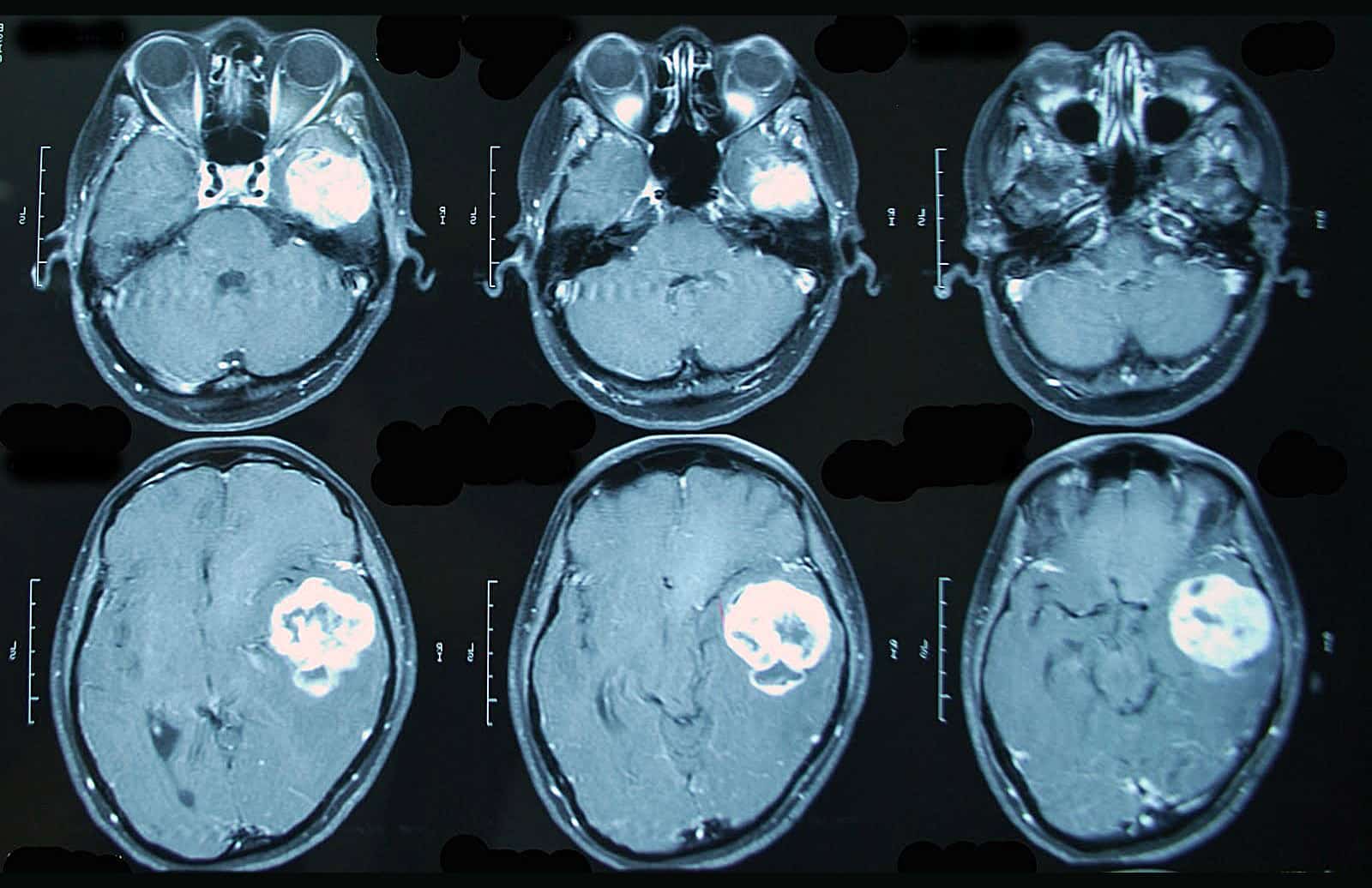 Опухоль головного мозга картинки