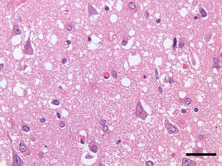 Фотография, сделанная с помощью светового микроскопа, демонстрирует губчатую дегенерацию коры головного мозга пациента, умершего от болезни Крейцфельдта — Якоба / © wikipedia