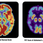 Впервые описаны случаи болезни Альцгеймера, приобретенной в результате заражения