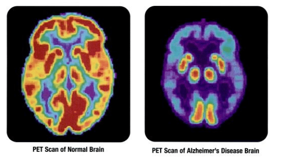 Впервые описаны случаи болезни Альцгеймера, приобретенной в результате заражения
