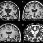 Ученые смоделировали разрушение человеческого мозга при семантической деменции