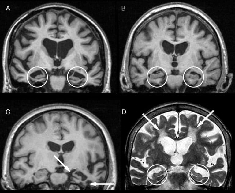Ученые смоделировали разрушение человеческого мозга при семантической деменции