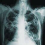 Медики развеяли главный миф о туберкулезе