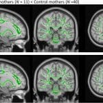 Томография показала особенности в мозге жестоких матерей