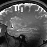 Неврологи обнаружили необычную причину мигрени