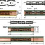 Метод пермских ученых предсказал поведение стента в коронарной артерии