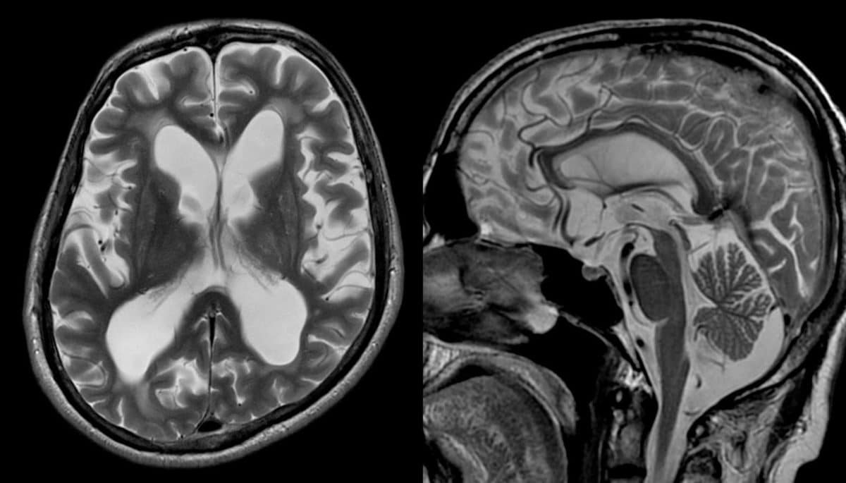 Увеличенные желудочки головного мозга пациента с гидроцефалией на МРТ