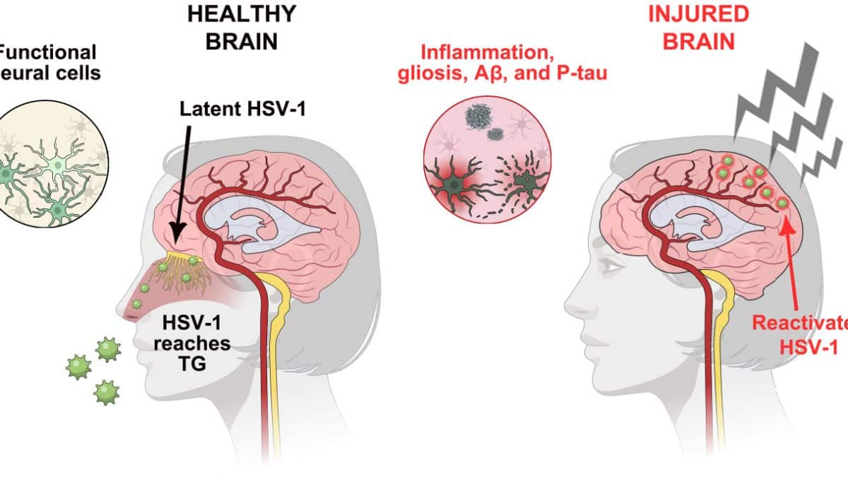 Ученые объяснили, как травмы головы могут запускать болезнь Альцгеймера через вирус герпеса