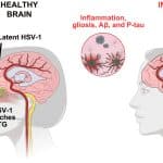 Ученые объяснили, как травмы головы могут запускать болезнь Альцгеймера через вирус герпеса