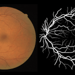 Искусственный интеллект ускорит постановку диагноза по снимку сетчатки глаза