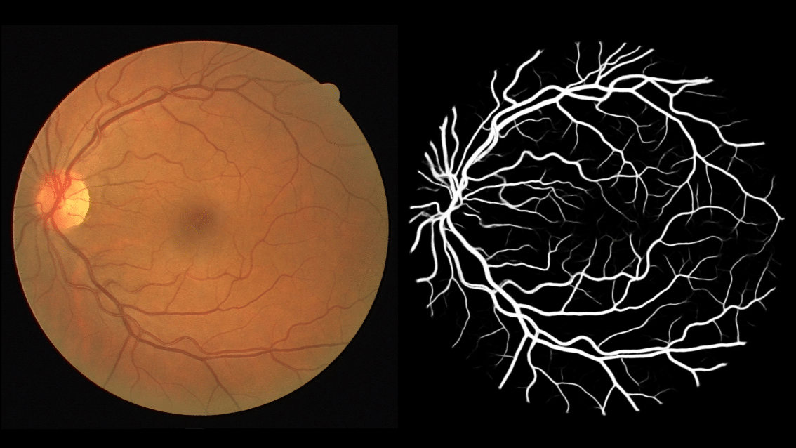 Искусственный интеллект ускорит постановку диагноза по снимку сетчатки глаза